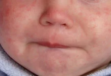 Nueva York ordena vacunación obligatoria contra de sarampión